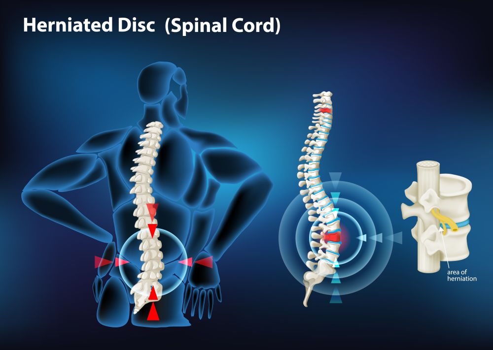 Illustration of the spine showing a herniated disc, with highlighted areas of pain, and a detailed view of where the herniation occurs. It also suggests chiropractic treatment for lower back pain to alleviate discomfort from a slipped disk.