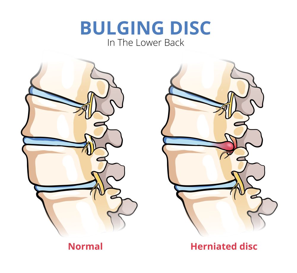 An illustration comparing a normal spine with a herniated disc in the lower back, where the herniated disc is highlighted in red. This visual aid can be invaluable when discussing chiropractic treatment of lower back pain with your chiropractor for a slipped disk.